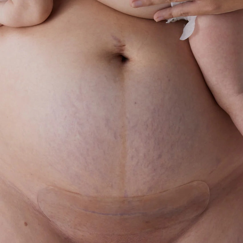 Silicone Gel Scar Strips Washable & Reusable on belly after c-section